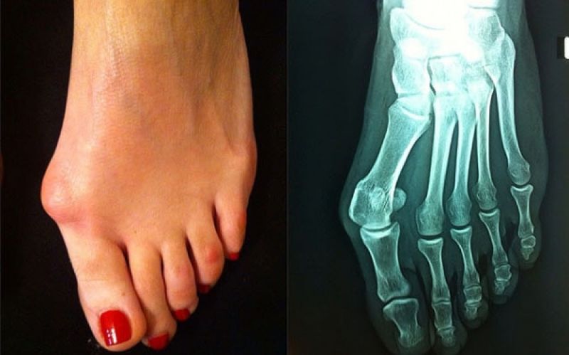 Βλαισός - Μεγάλος Δάκτυλος - Κότσι