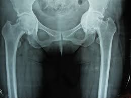 Οστεοαρθρίτιδα Ισχίου