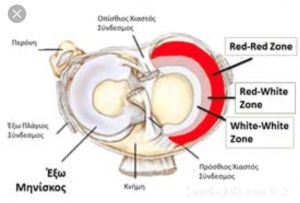 Ρήξη Μηνίσκου